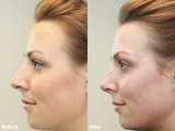 Profile Photos of Nose Reshaping Surgery in Mumbai  at Aesthetic Clinic