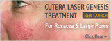 Redness/rosacea laser treatment