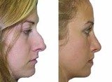 Profile Photos of Nose Reshaping Surgery in Mumbai – Aesthetic Clinic