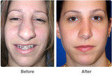 Profile Photos of Nose Reshaping Surgery in Mumbai – Aesthetic Clinic