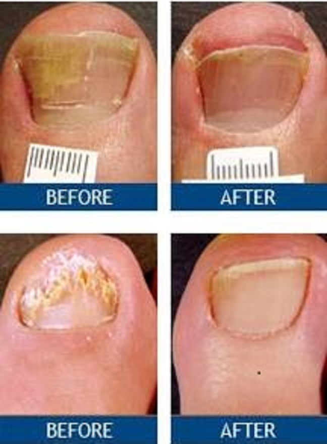  New Album of Laser Nail Therapy- Largest Toenail Fungus Treatment Center 1050 N. Point Rd. Suite 200 - Photo 3 of 3