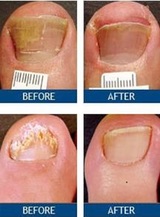  Laser Nail Therapy- Largest Toenail Fungus Treatment Center 1050 N. Point Rd. Suite 200 