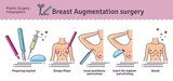 Profile Photos of Breast Enlargement London