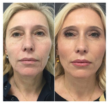 Profile Photos of Best Lip Filler & Injections