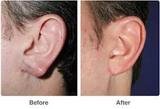 Profile Photos of Ear Reshaping Surgery at Aesthetic Clinic