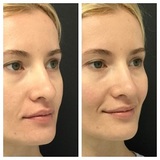 Profile Photos of Microdermabrasion Facial