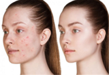 Profile Photos of Chemical Peel