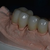 Teeth Retainer After Braces, Brooklyn