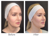 Profile Photos of Microneedling with PRP