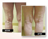 Before and After Pictures of USA Vein Clinics