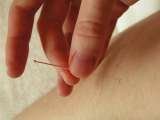 hair-thin sterile needles are inserted into acupuncture points to regulate the flow of energy in the body