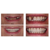  Full Mouth Dental Implants Turkey healthcentersantalya 