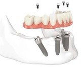Dental Treatment of Dental Implants