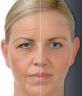 Profile Photos of Botox and Dermal Fillers  NI