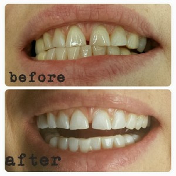  Profile Photos of Hsmile Teeth Whitening & Dental Hygiene 10376 Yonge Street, unit 202 - Photo 3 of 4