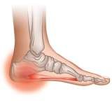 heel spurs, Foot Solutions - Best Comfortable Shoes, Annapolis