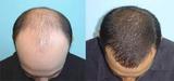 Profile Photos of Hair Transplant in Delhi Ncr
