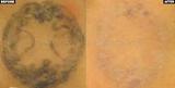Profile Photos of Pigmentation Tattoo Removal