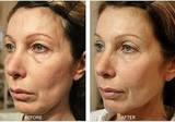 Profile Photos of Thermage Skin Tightening Treatment in Delhi