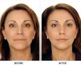 Profile Photos of Botox Cost