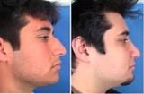 Profile Photos of Cosmetic Surgery For Men Face
