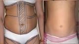 Profile Photos of Liposuction in Delhi