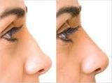 Profile Photos of Nose Surgery in Delhi Price
