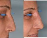 Profile Photos of Best Nose Surgery in Delhi