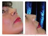Profile Photos of Nose Surgery in Delhi Cost