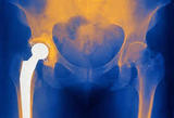 Profile Photos of Cost of Hip Replacement