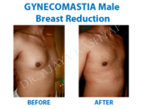 Gynecomastia Surgery in Delhi | Male Breast Reduction in Delhi,, India