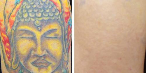  Profile Photos of InkAway Laser Tattoo Removal 220 Wilmington West Chester Pike - Photo 2 of 4