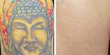 InkAway Laser Tattoo Removal, Chadds Ford