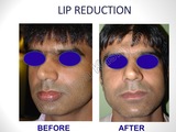 Lip Reduction Surgery in Delhi