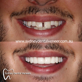 Poor gentleman didn't want to smile for us before my work. Now he smiles too wide. A good problem to have. 
1.5 year review. Good to see he's enjoying them.

#smilemakeover #cosmeticdentistry #cosmeticdentist #dentalveneers #smile #instasmile