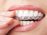 teeth with whitening tray, Portage Park Dentist, Chicago