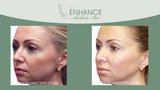 Before and After of ENHANCE Aesthetic Arts - Cosmetic MediSpa Services
