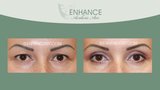 Before and After of ENHANCE Aesthetic Arts - Cosmetic MediSpa Services