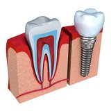 Pricelists of Dental Veneers & Lumineers