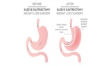 New Album of Gastric Sleeve Surgery