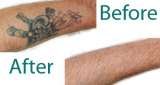 Laser Hair Removal Service, Tattoo Removal Service, Botox, Dermatologist, Hair Removal Service