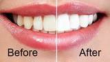 Profile Photos of Teeth Whitening Tools