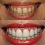 Profile Photos of Best Dental Implants