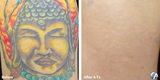 Profile Photos of Eraser Clinic Laser Tattoo Removal