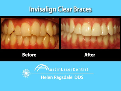 Invisalign Before After Austin TX Profile Photos of Austin Laser Dentist - HelenRagsdale DDS 11615 Angus Rd, Ste 101 - Photo 1 of 4