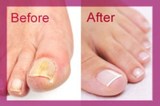 Profile Photos of Nail Fungus Home Remedy - The Anti-Fungal Solution From Zeta Clear