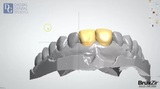New Album of Dental Crowns Lab NYC