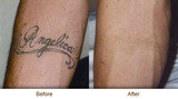 Profile Photos of Tattoo Removal in Mumbai - Aesthetic Clinic