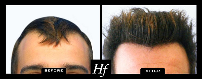 Hair Free Laser Skin Clinics Toronto Profile Photos of Hairfree Laser Skin Clinics 2100 Bloor St W #7b, - Photo 2 of 2